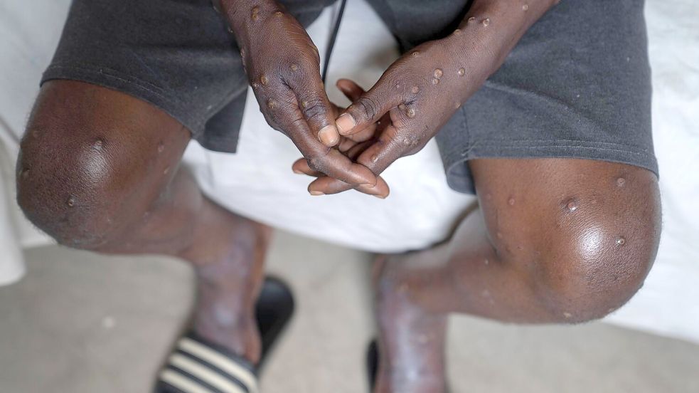 Mehrere Mpox-Ausbrüche in Afrika und eine neue womöglich gefährliche Variante bedrohen die öffentliche Gesundheit weltweit. (Archivbild) Foto: Moses Sawasawa/AP