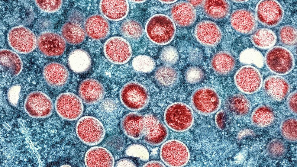 Die Weltgesundheitsorganisation (WHO) hatte im August wegen der zunehmenden Mpox-Verbreitung in Afrika eine „Gesundheitliche Notlage internationaler Reichweite“ erklärt. Foto: -/National Institute of Allergy and Infectious Diseases/dpa