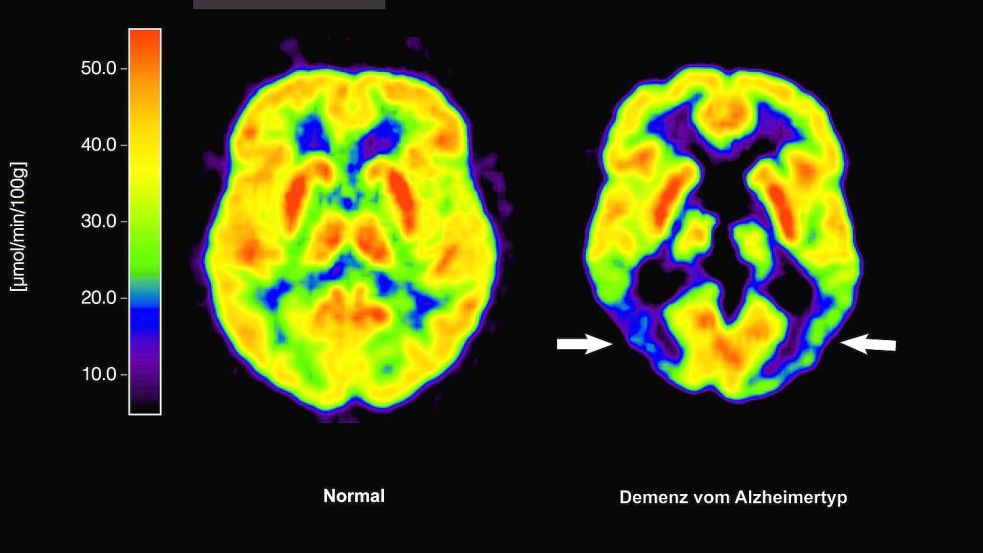 Haben die Amyloid-Plaques schon irreversible Schäden im Gehirn angerichtet, nützt ihre Entfernung nichts mehr. (Archivbild) Foto: picture alliance / dpa