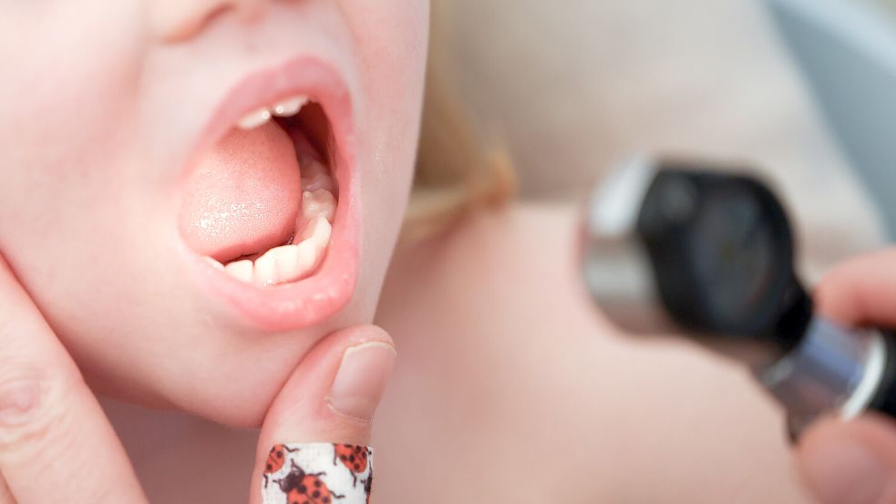 Eine Kinderärztin untersucht bei einem Mädchen den Mund- und Rachenraum mit einem Otoskop. Der Blick in den Mund gibt bei Scharlach für die Kinderärzte schnell Aufschluss. Denn Belag des Rachens und eine typisch gerötete Zunge gehören zu den Symptomen. Foto: DPA/Christian Charisius